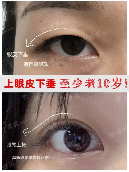 眼皮下垂怎么办71不提眉做双眼皮后年轻10岁