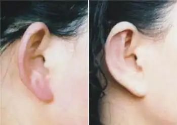 耳廓畸形都有哪些症状表现