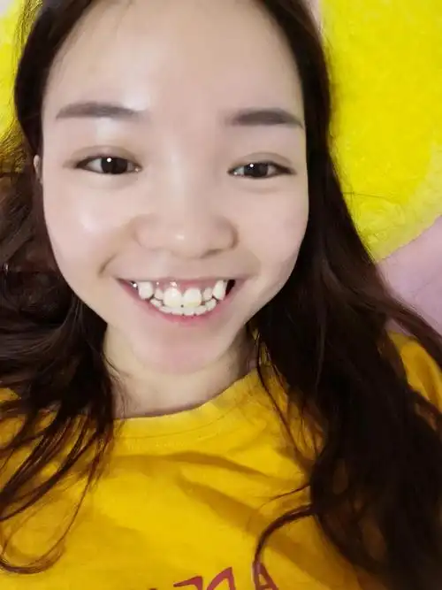 楼主28岁,门牙黄,还有两个虎牙,咨询过美白,说要把虎牙戴牙套套下来