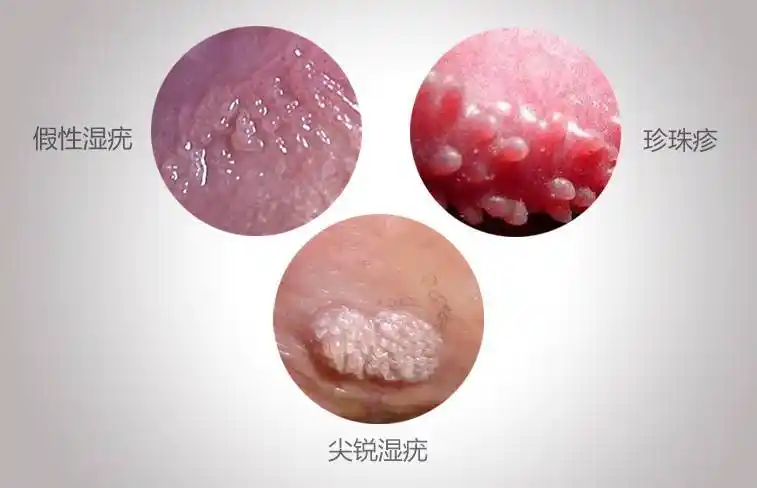 假疣和真疣的图片对比生殖器部位长了增生物不一定都是尖锐湿疣,也