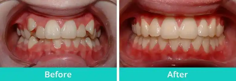 虎牙矫正前后对比图