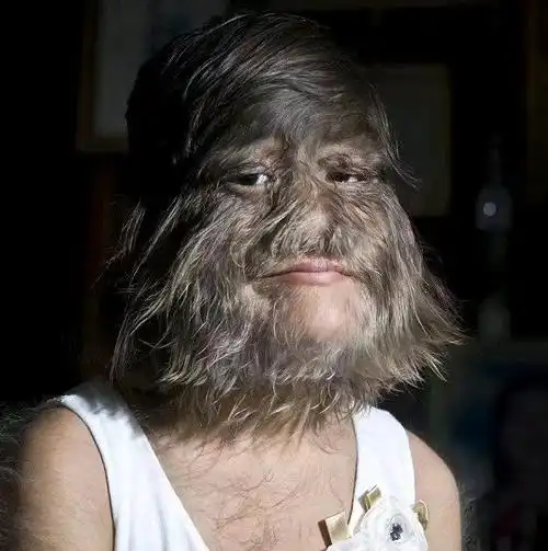 世界上最多毛的女孩剃掉了毛竟然长这么样不敢相信