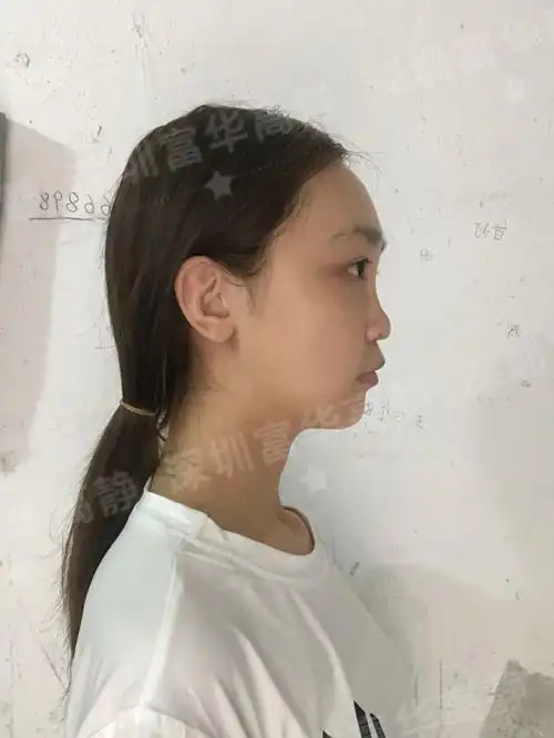 术前诊断术前患者从侧面来看山根低平,鼻梁塌陷比较严_圈子-新氧美容