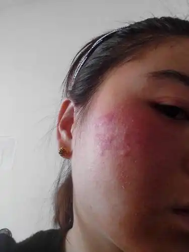 治疗皮肤过敏的药物,冬季易陷入的护肤误区