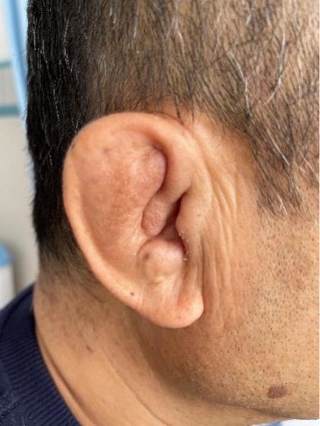 李和平医生的注意,在他的询问下,权先生表示,自己的耳朵没有受过外伤