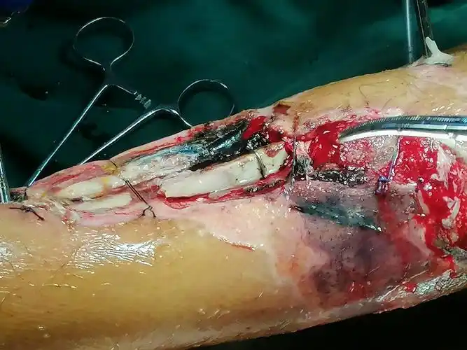 赣州市立医院骨科成功保下患者左小腿.