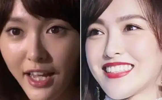 明星整牙前后气质变化圈内素有整牙即整容的说法,虽然_圈子-新氧美容