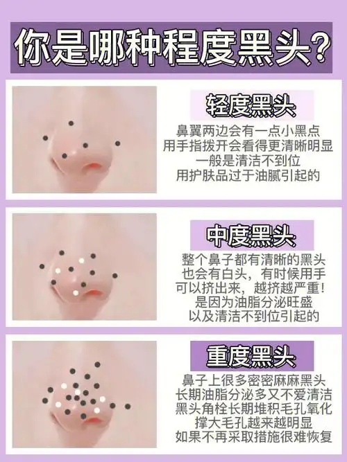 去黑头好方法奶油鼻养成