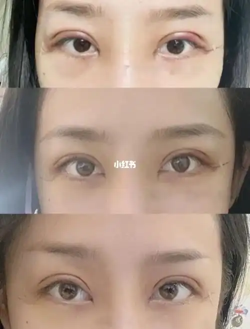 全切双眼皮恢复半年_全切双眼皮_双眼皮手术_刘亦菲_美妆_医美整形