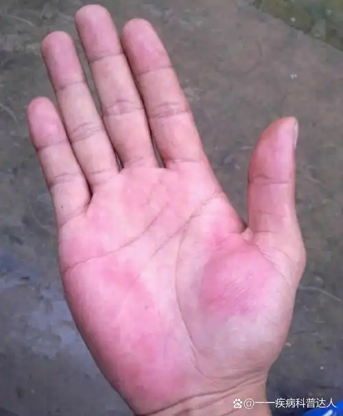 好多人都在后台给我留言发图片,问她的手掌发红是不
