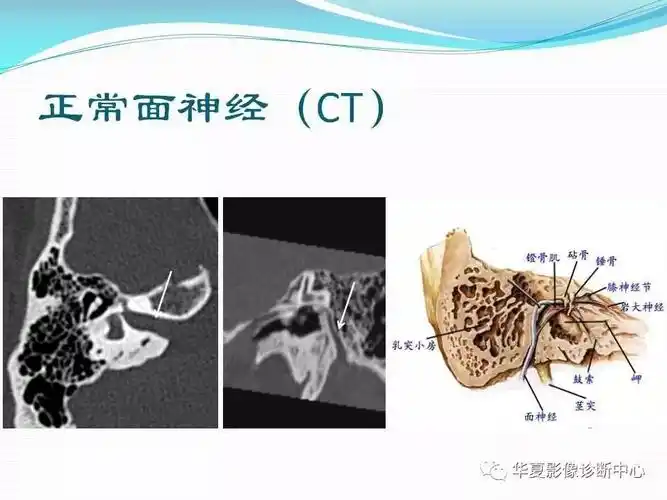 面神经解剖及常见病变影像诊断