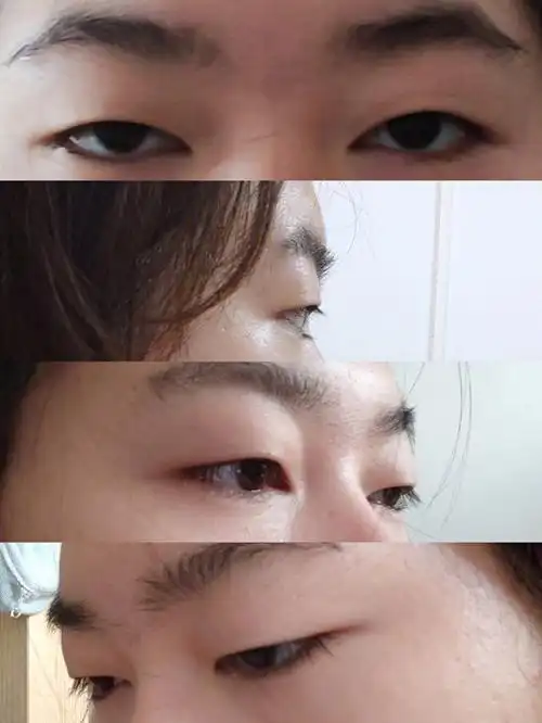 上睑肌无力肿眼泡初眼深圳面诊记录