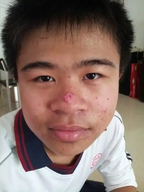 我儿子15岁,鼻子尖长个很大的痤疮,都没办法消掉,有啥药可以治疗的吗?