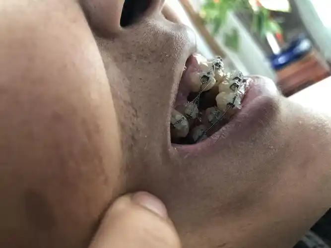 3号恒虎牙,叠在4号牙的位置.刚把3号乳牙拔掉,同时在做自锁矫正.