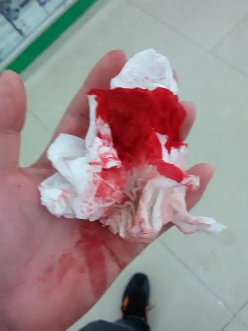 昨天我去上班,上班就发现身上背上流了很多血,还以为是自己碰到那里了