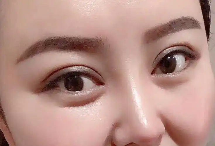 什么样的双眼皮形状最好看目前流行哪种双眼皮形态