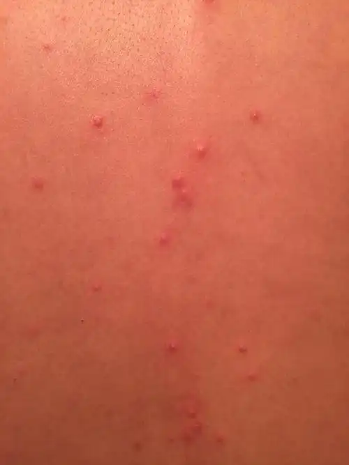 后背突然起了很多红色的小疙瘩