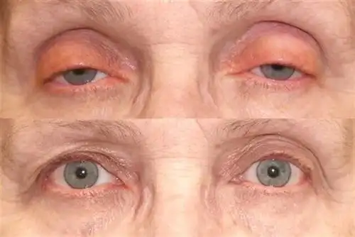 上睑下垂【多图】_39医疗图集-39健康网