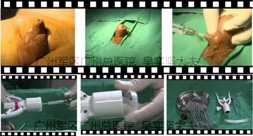 图解一次性包皮环切缝合器手术过程