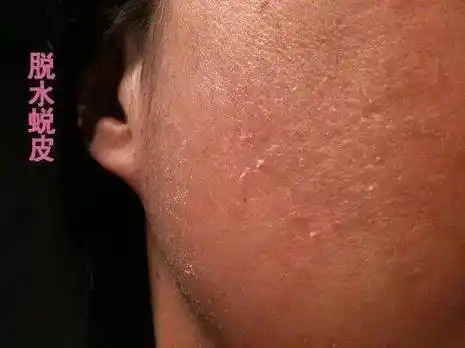 脸上角质层过薄,如何增厚角质层?_肌肤_皮肤_产品