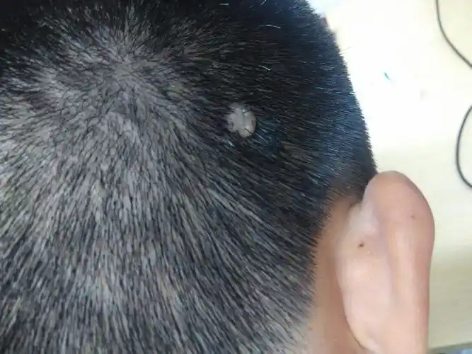 我的头皮上有个小的肉瘤,怎么办?