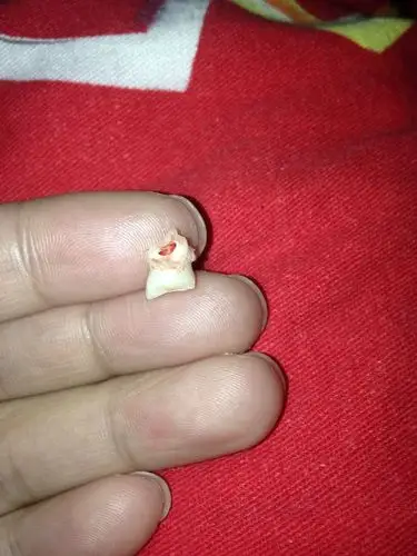 拔了一颗,边上的牙齿也不牢吧?是不是马上也会松掉?拔