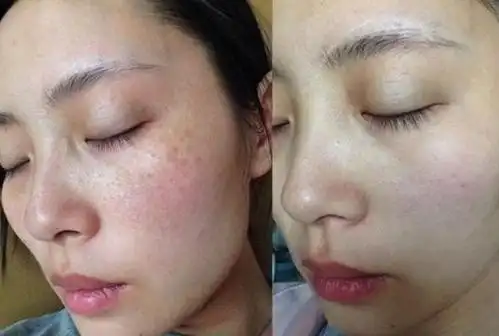 用这款美白祛斑霜,已经有小半年的时间,使用前后的对比真的是超级的