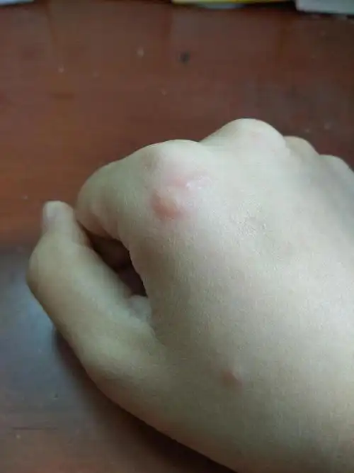 水土不服,长了一身疙瘩