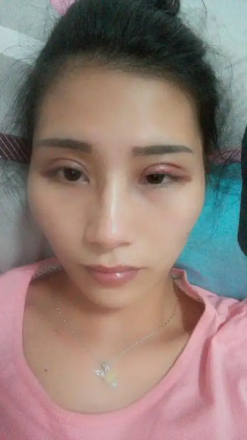 刚割双眼皮第二天,是不是有点宽了,?好担心.
