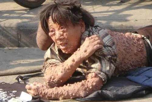 刚刚在网上看到这么一张图太恶心了我想问问这是什么病怎么会变成这样