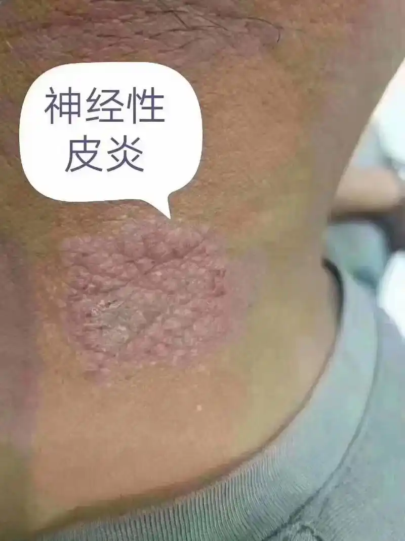 苗护草;蚁毒膏专治各种皮肤骚痒.蚊虫叮咬.脚气,脚臭等等 - 抖音