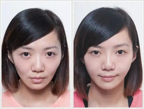 只带了上牙套,没有下牙套,后面会不会咬合有问题呀?