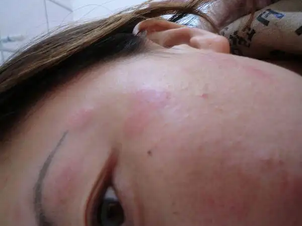 皮肤过敏的主要症状就是皮肤泛红,干燥脱屑