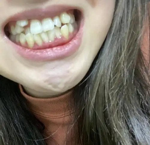 求助骨性地包天16度牙排列拥挤虎牙矫正后上牙会代偿性前倾变成小龅牙