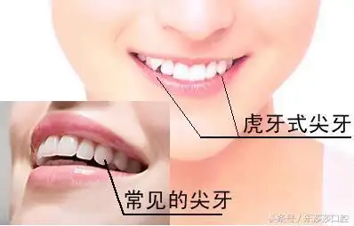 尖牙的位置占据导致后萌出的尖牙被「挤到弓牙以外的位置上」形成虎牙