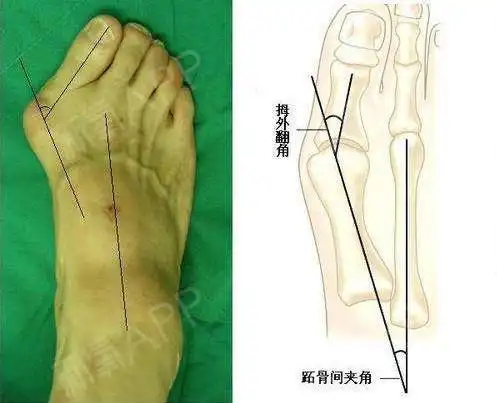 "很多求美者不愿做拇外翻手术的原因是她们担心术后留下难看的疤痕