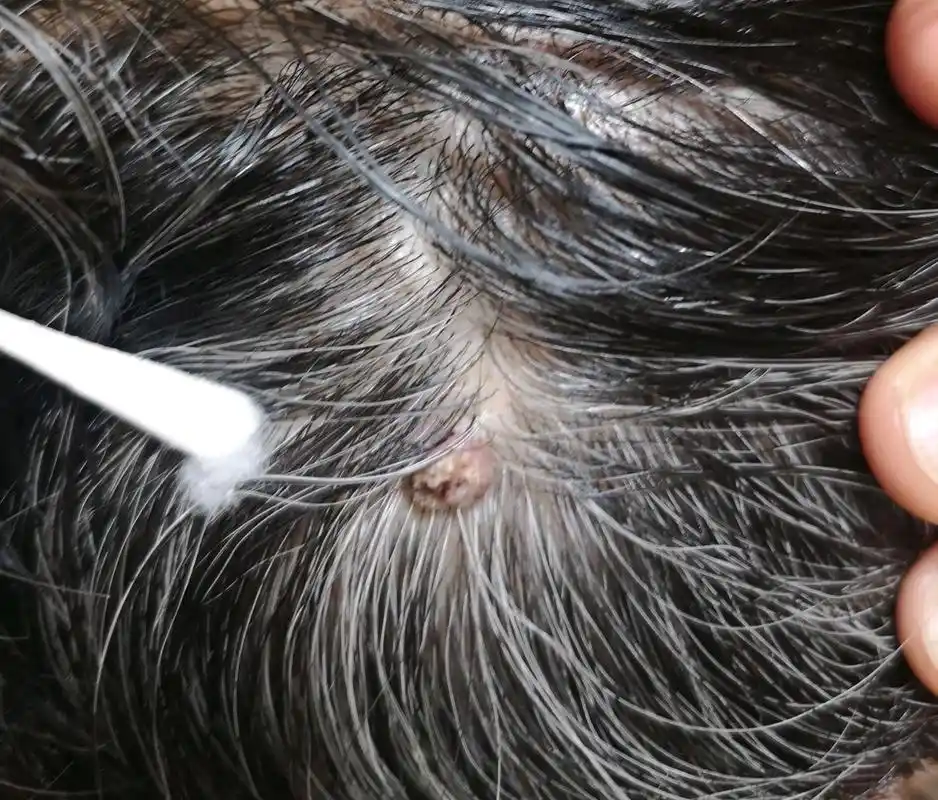 头顶一颗赘生物,会是什么呢?皮脂腺痣?