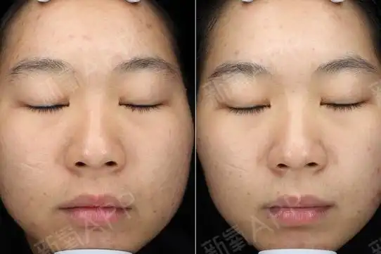 果酸换肤效果图,4大优点,令你焕然一新!