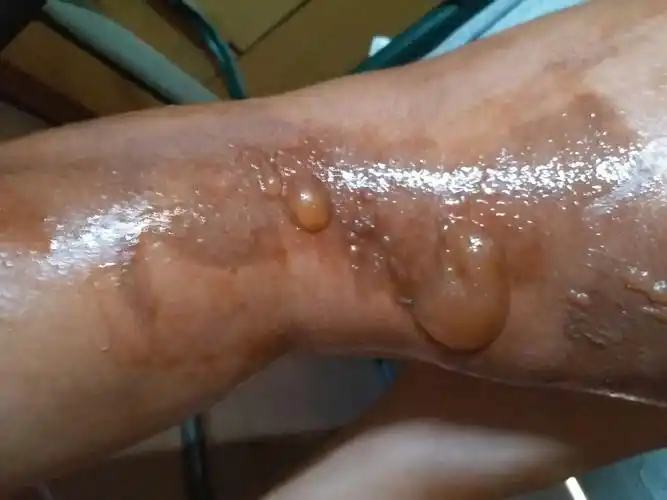 被烫伤了.水泡应该怎么处理 还挺大的,应不应该把积液给弄出来?