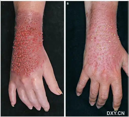 【medical-news】密集物恐惧症者慎入: 一例诡异的疣状皮疹