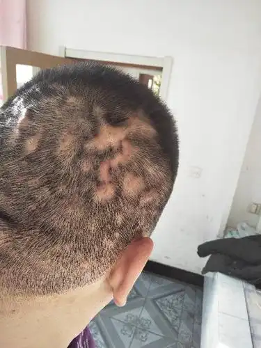 头上出来很多脓包,有人知道什么病么?怎么治疗啊?