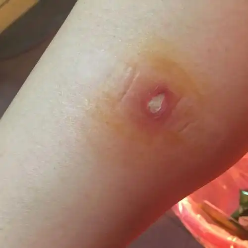 之后又多次消毒加涂烫伤膏,离烫伤已有15天了,腿还是图