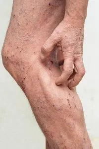 有皮肤瘙痒和干燥问题的人照片