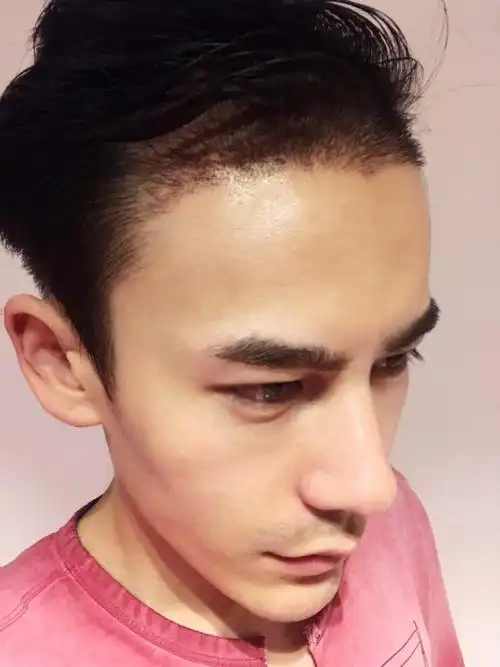 代先生种植发际线手术15天后日记分享