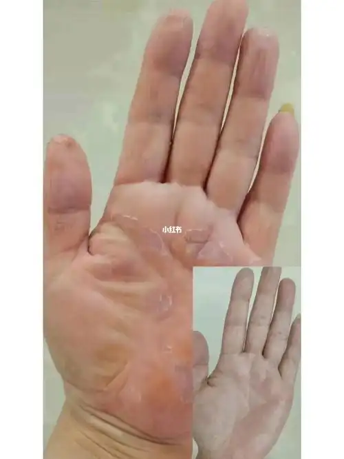 鹅掌风调理前后对比