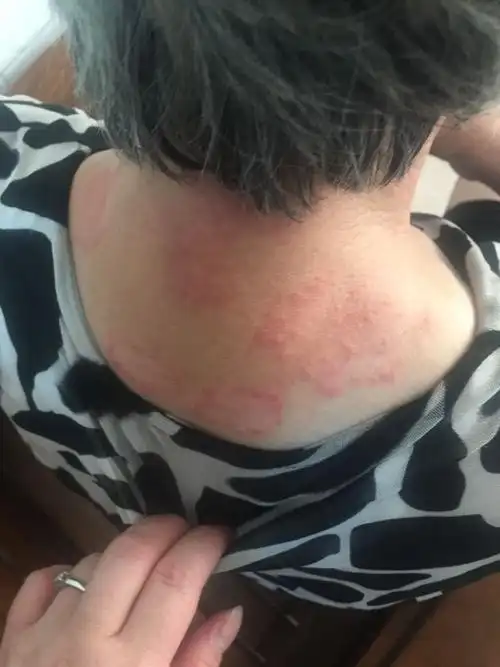 我婆婆后颈脖上长了一圈一圈的红色疹子,痒痒的,是