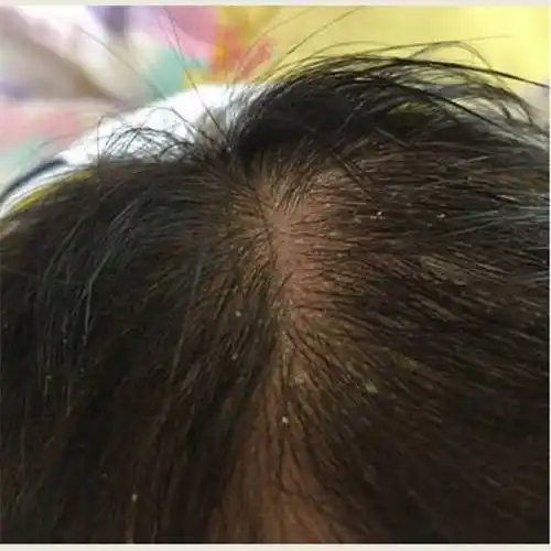 儿童毛囊炎用什么洗发水