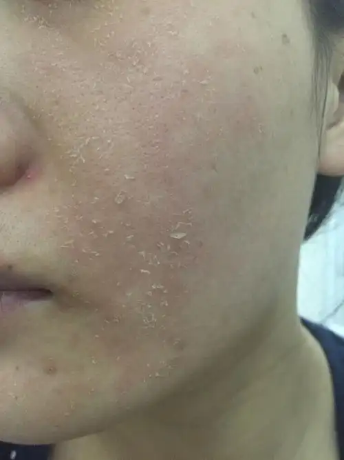 一开始脸非常痒,很红,抹上霜会很痛,几天后脸开始脱皮.