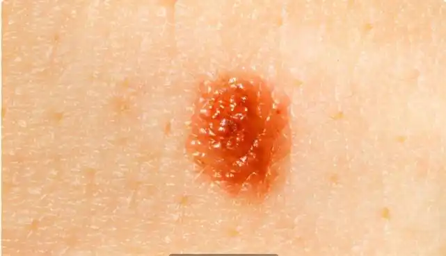 35岁男子皮肤出现"蜘蛛痣",常用1物,肝病"绕道走"|肝病|肝癌|肝硬化