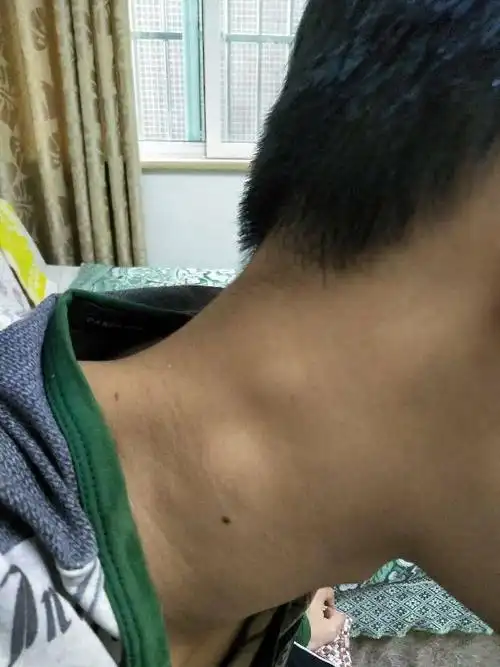 脖子两边张了个包怎么回事求救,是不是淋巴,该怎么治,恳求各位网友